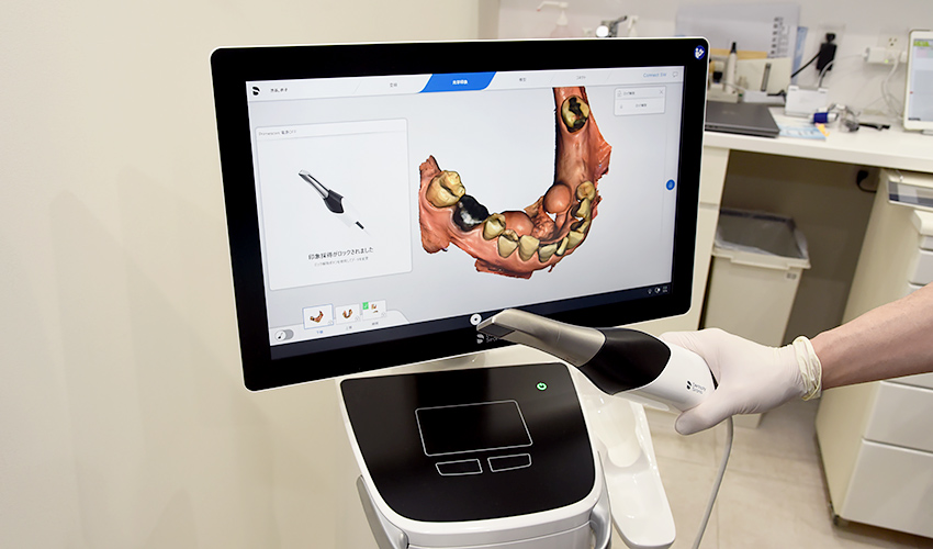 口腔内スキャナー